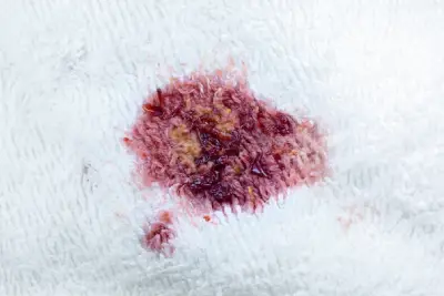 Blood Removal from Carpet